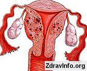 Adenomyozis: Belirtiler, Nedenler ve Tedavi Adenomyozis: Belirtiler, Nedenler ve Tedavi
