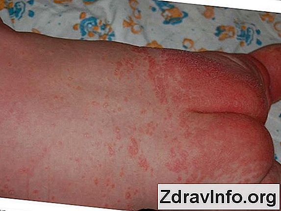 Алергія у дітей