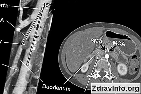 Kötü kan dolaşımı: nedenleri, belirtileri, sonuçları. Serebral dolaşım bozuklukları: semptomlar ve tedavi Kötü kan dolaşımı: nedenleri, belirtileri, sonuçları. Serebral dolaşım bozuklukları: semptomlar ve tedavi