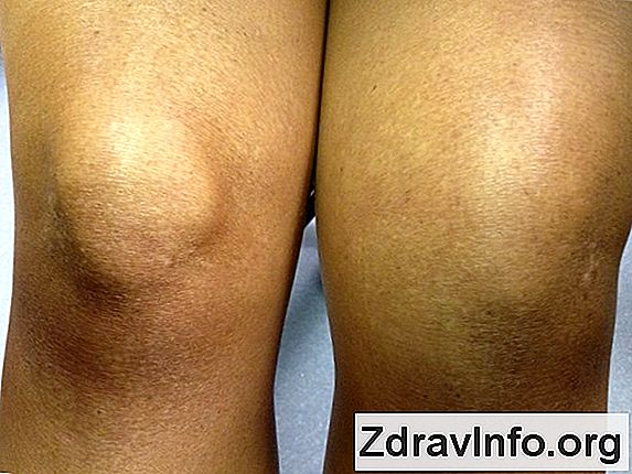 osteoartritis koljena i njeno liječenje)