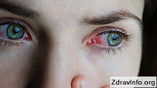 Zapobieganie i leczenie zapalenia spojówek u dorosłych w domu: środki folk, leki i krople do oczu