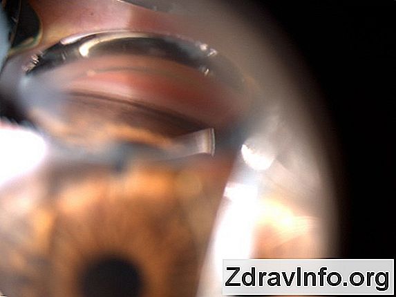Czym jest zapalenie siatkówki oka? Objawy i leczenie choroby
