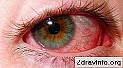 Symptetyczne oftalmia - ważne jest, aby rozpocząć leczenie na czas, aby zaoszczędzić oko