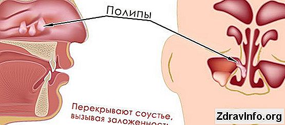Поліпозно Синусит: Симптоми І Лікування Захворювання Причини, симптоми і лікування поліпозного і кістозного синуситу