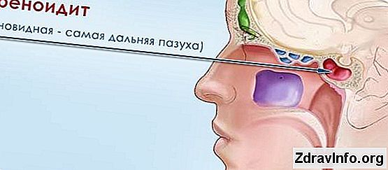 Після Застуди Болить Голова Головний біль після застуди, чи варто турбуватися через неї?