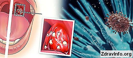 Foliküler boğaz ağrısı: acil ilaç Foliküler boğaz ağrısı: acil ilaç