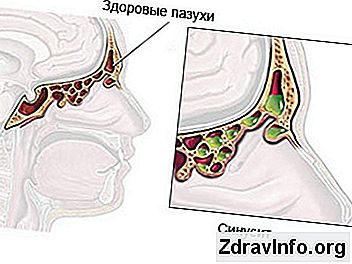 Ostrego Zapalenia Zatok: Przyczyny I Leczenie Ostrego Szczęki I Ostre Ropne Zapalenie Zatok Ostrego zapalenia zatok: objawy i sposoby postępowania w zależności od postaci choroby