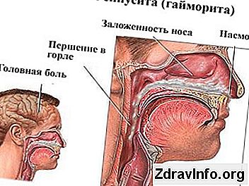 Nieżytowym Zapaleniem Zatok: Objawy, Przyczyny I Leczenie Nieżytowym Zapaleniem Zatok Nieżytowe zapalenie zatok: gatunki przyczyny i głównych objawów