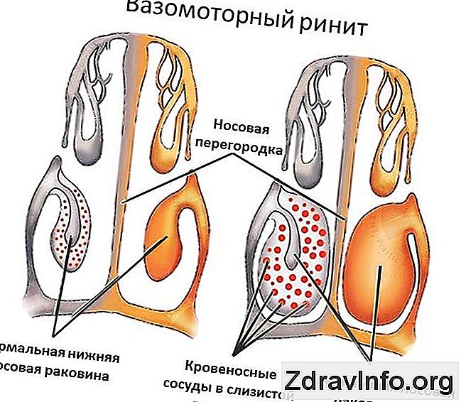 vazomotorni rinitis hipertenzija)
