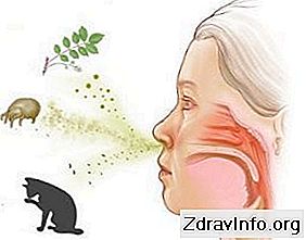 Як лікувати алергічний кашель: алергічний