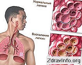 Симптоми и лечение на пневмония 👃 Портал На Синусите И Др. - 2024