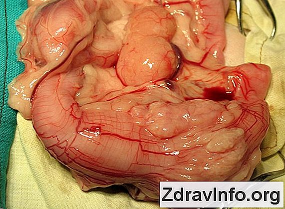 Zapalenie Okrężnicy W Nosie Przy Odbijaniu Zapalenie okrężnicy w nosie, jak ją leczyć?