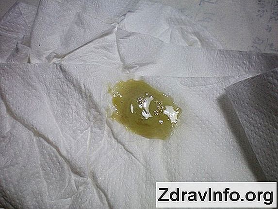 Plwociny Przez Kaszel Sputum wychodzi z kaszlem, czy to z powodu zapalenia zatok?