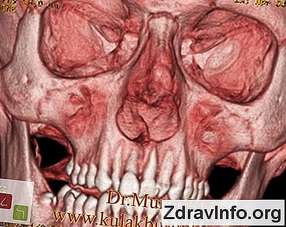 Çocuklarda Cephede - Belirtileri Ve Tedavisi Bir çocukta belirtiler ve sinüzit tedavisi