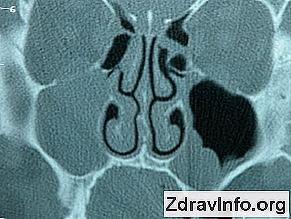 Zapalenia Zatok Przynosowych U Dzieci: Objawy, Leczenie I Przyczyn Choroby Leczenie zapalenia zatok przynosowych u dzieci
