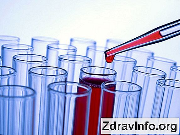 Поліпозно Риносинусит, Його Лікування І Симптоми Як проявляється хронічний поліпозний риносинусит і як його лікувати?