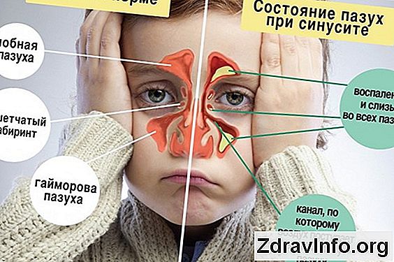Антибіотики При Фронтите, Які Вибрати - Амоксицилін, Цефтріаксон Або Сумамед? Фронтит - лікування антибіотиками