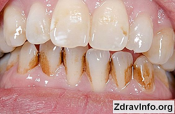 Sphenoiditis: Simpa, Przyczyny, Leczenie Jak rozpoznać i leczyć zapalenie ksenoidalne?