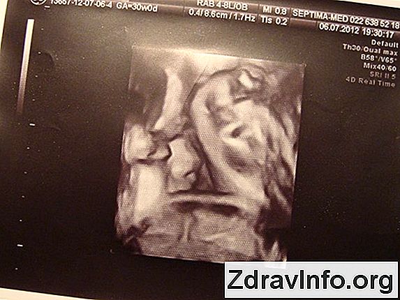 Syfilityczne Ból Gardła: Objawy I Leczenie Objawy rozwoju syfilitycznego zapalenia gardła, co musisz wiedzieć o tej chorobie?
