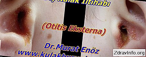Otitis Eksterna: Belirtileri Ve Tedavisi, Zaman Bir Kulak Ağrısı Ne Yapmalı? Otit eksterna: İlk semptomlardan kadar tam iyileşme