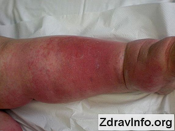 Antybiotyki Na Zapalenie Zatok, Ich Skuteczność I Skutki Uboczne, W Niektórych Przypadkach, Przepisane Leczenie Zapalenia Zatok Antybiotykami W niektórych przypadkach antybiotyki są przewidziane dla zapalenia zatok