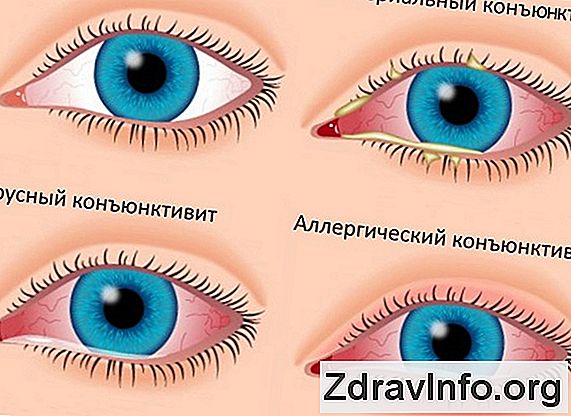 Гострий Синусит: Причини Виникнення Та Лікування Гострого Верхньощелепного І Гострого Гнійного Синуситу Гострий синусит: симптоми і методи лікування в залежності від форми перебігу хвороби