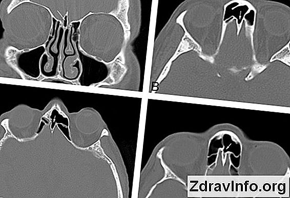 Синусит: Що Це І Які Симптоми І Ознаки Синуситу У Дорослих І Дітей Синусит: що це і чому виникає