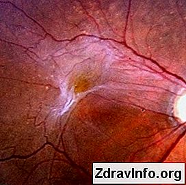 Wszystko na temat epiretinalnej błony oka: co to jest i jak ją leczyć?: epiretinalnej