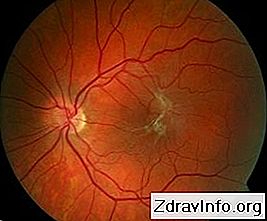 Wszystko na temat epiretinalnej błony oka: co to jest i jak ją leczyć?: może