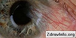 Wszystko na temat epiretinalnej błony oka: co to jest i jak ją leczyć?: temat