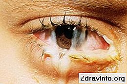 Краплі для очей Диклофенак - інструкція із застосування. Універсальний протизапальний розчин: диклофенак