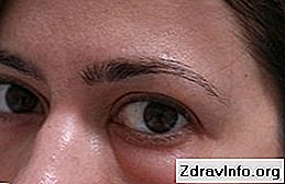 Очні краплі Офтальмоферон - докладно інструкція із застосування. Для лікування вірусних хвороб ока: краплі