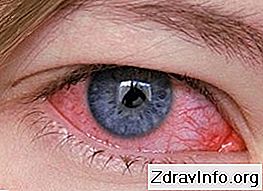 Очні краплі Офтальмоферон - докладно інструкція із застосування. Для лікування вірусних хвороб ока: офтальмоферон
