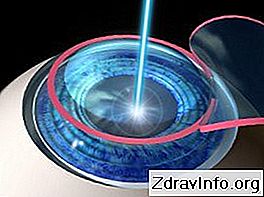 W jaki sposób zaćma jest leczona laserem i chirurgicznie? Wskazania i przeciwwskazania: wskazania