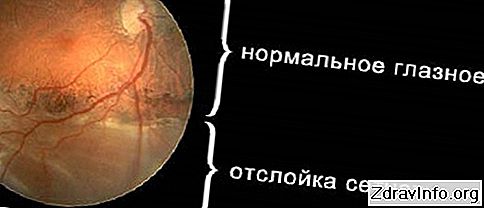 Симптоми відшарування сітківки ока: чому захворювання вважається небезпечним? (симптоми) Симптоми відшарування сітківки ока: чому захворювання вважається небезпечним?: симптоми