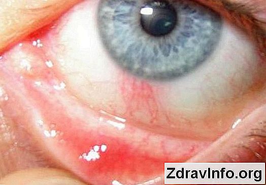 praska žila u oku hipertenzije)