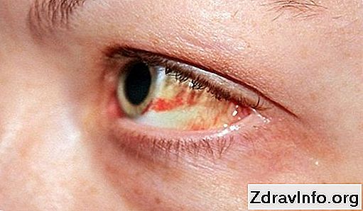 praska žila u oku hipertenzije