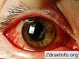 praska žila u oku hipertenzije