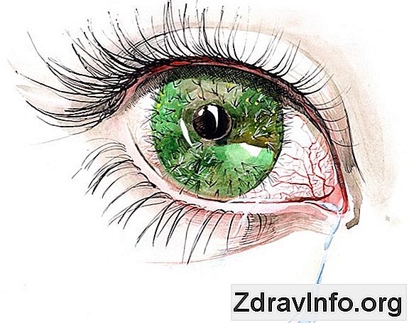 Kuru göz sendromu hastalığı tedavisi: halk ilaçları veya ilaçlar?