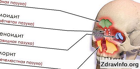 Adenoid: nedir bu, semptomlar, tedavi, kaldırma Adenoid: nedir bu, semptomlar, tedavi, kaldırma