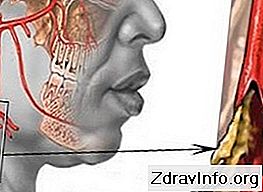 Serebral Ateroskleroz Nasıl Tedavi Edilir Serebral Ateroskleroz Nasıl Tedavi Edilir