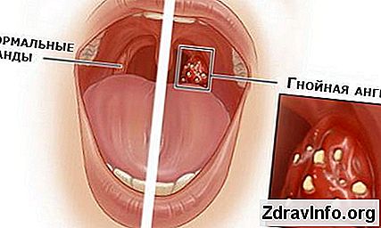 Boğazda pürülan boğazda tedavi: en etkili yöntemler Boğazda pürülan boğazda tedavi: en etkili yöntemler
