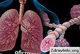 Obstrüktif bronşit nedir Obstrüktif bronşit nedir