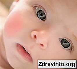 Лікування алергії у дитини: дитини
