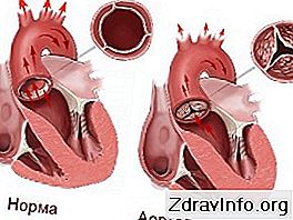 Leczenie zwężenia zastawki aortalnej: leczenie