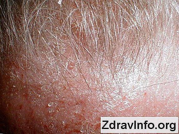 Лечение на вулвата левкоплакия 👃 Портал На Синусите И Др. - 2023