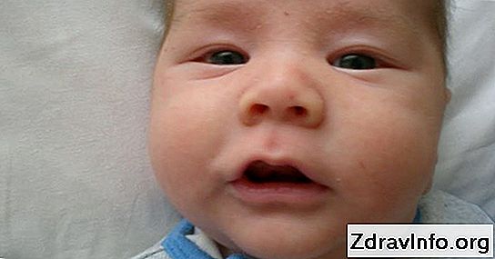Foliküler boğaz ağrısı: acil ilaç Foliküler boğaz ağrısı: acil ilaç