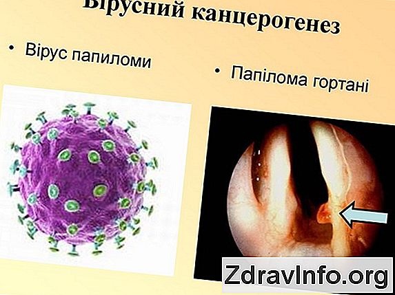 Вірусний тонзиліт: симптоми і ознаки
