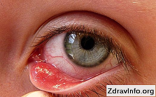 Arpa üst göz kapağında nasıl tedavi edilir Arpa üst göz kapağında nasıl tedavi edilir