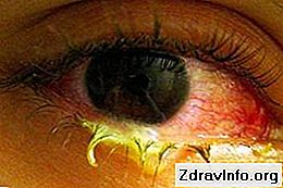 Najskuteczniejsze krople przeciwzapalne dla oczu. Najlepsze udogodnienia dla dorosłych i dzieci: dzieci